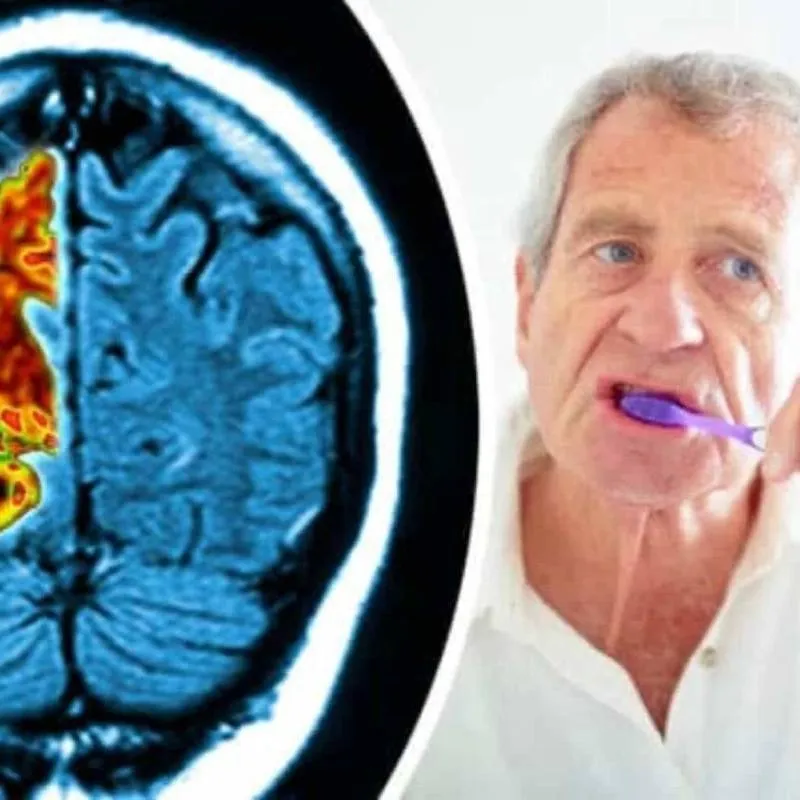 Alzheimer’ın Şaşırtıcı Sebebi Diş Eti Hastalıkları Olabilir